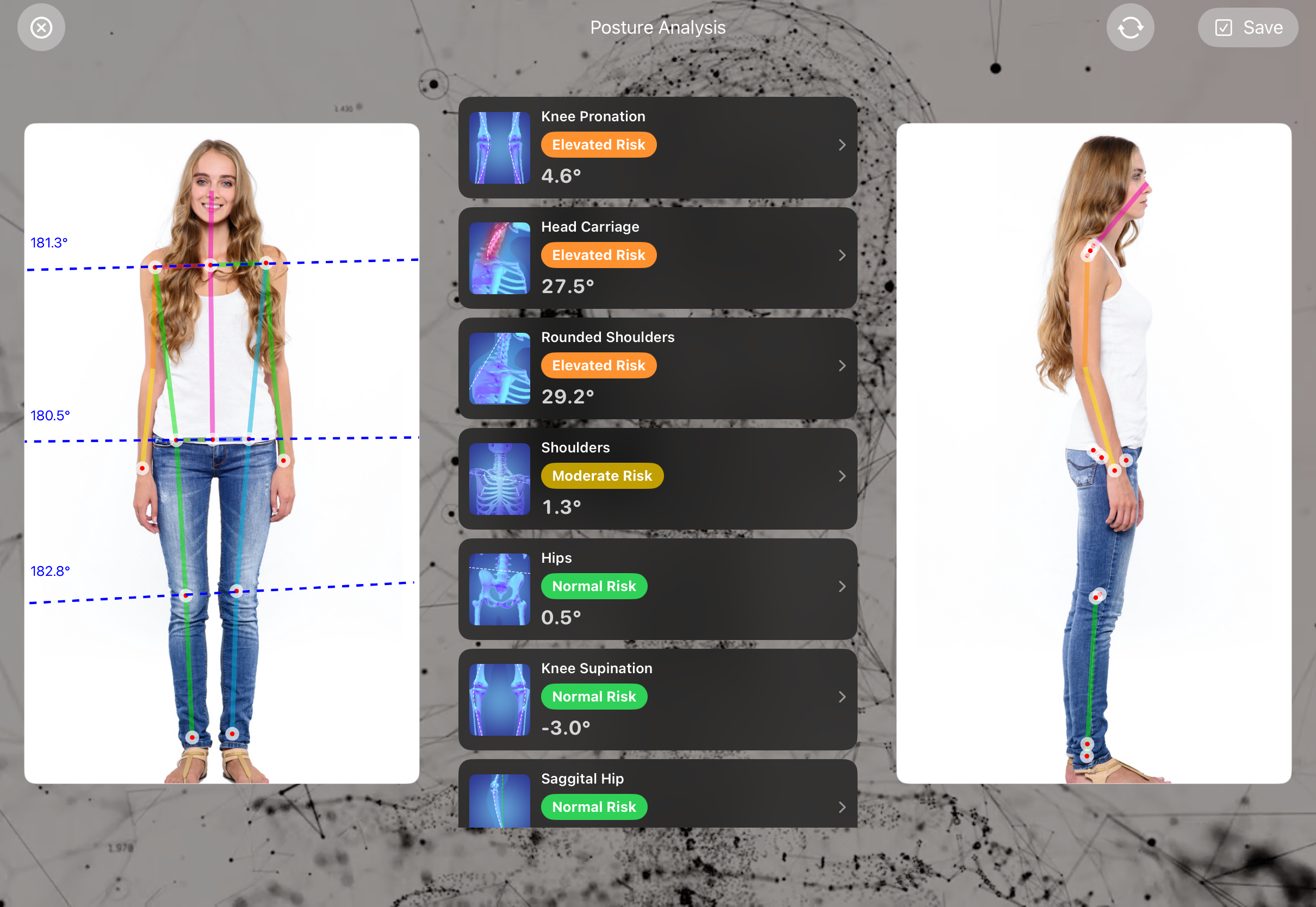 Posture analysis with anterior and lateral views in FitsPro